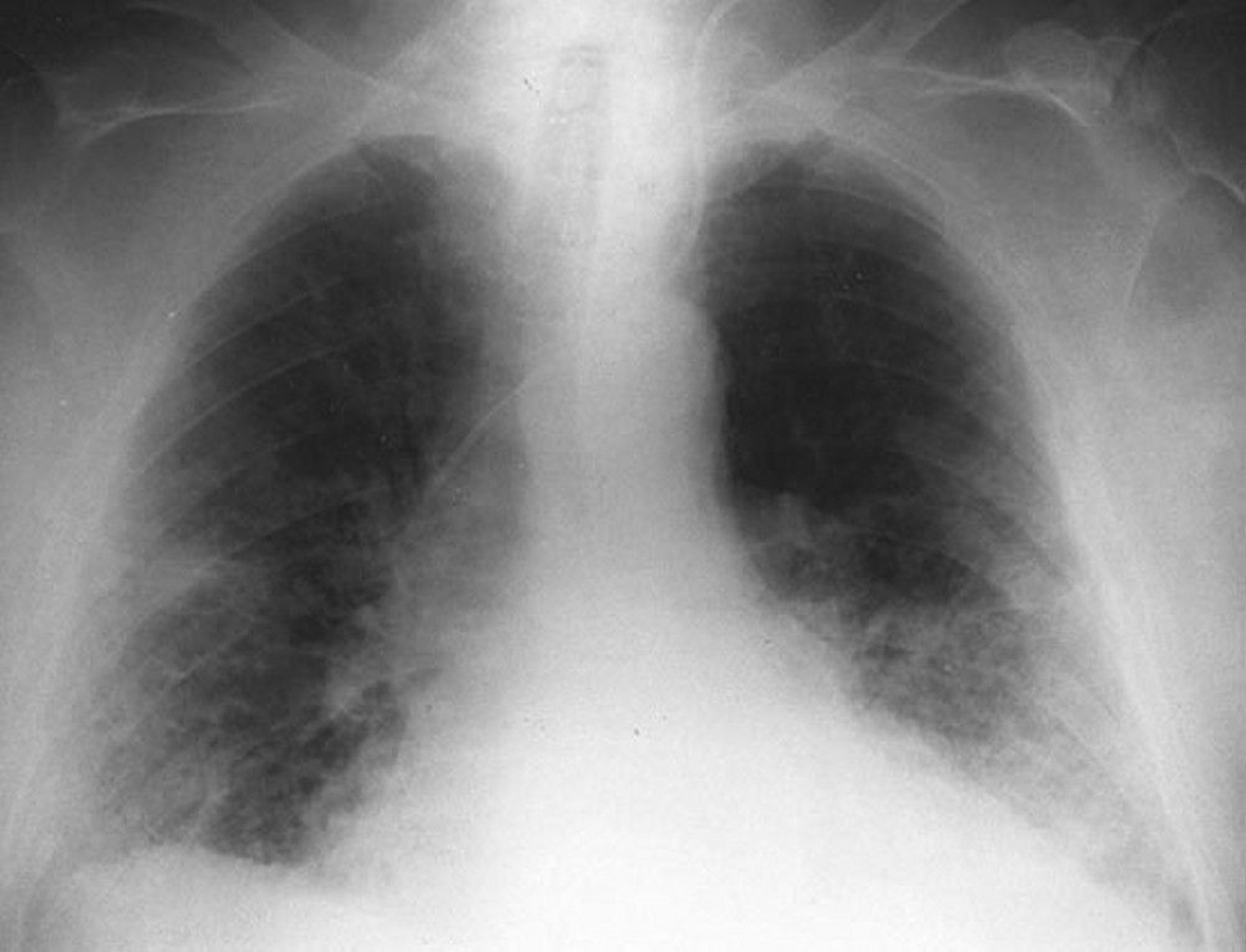 Interstitial Opacities