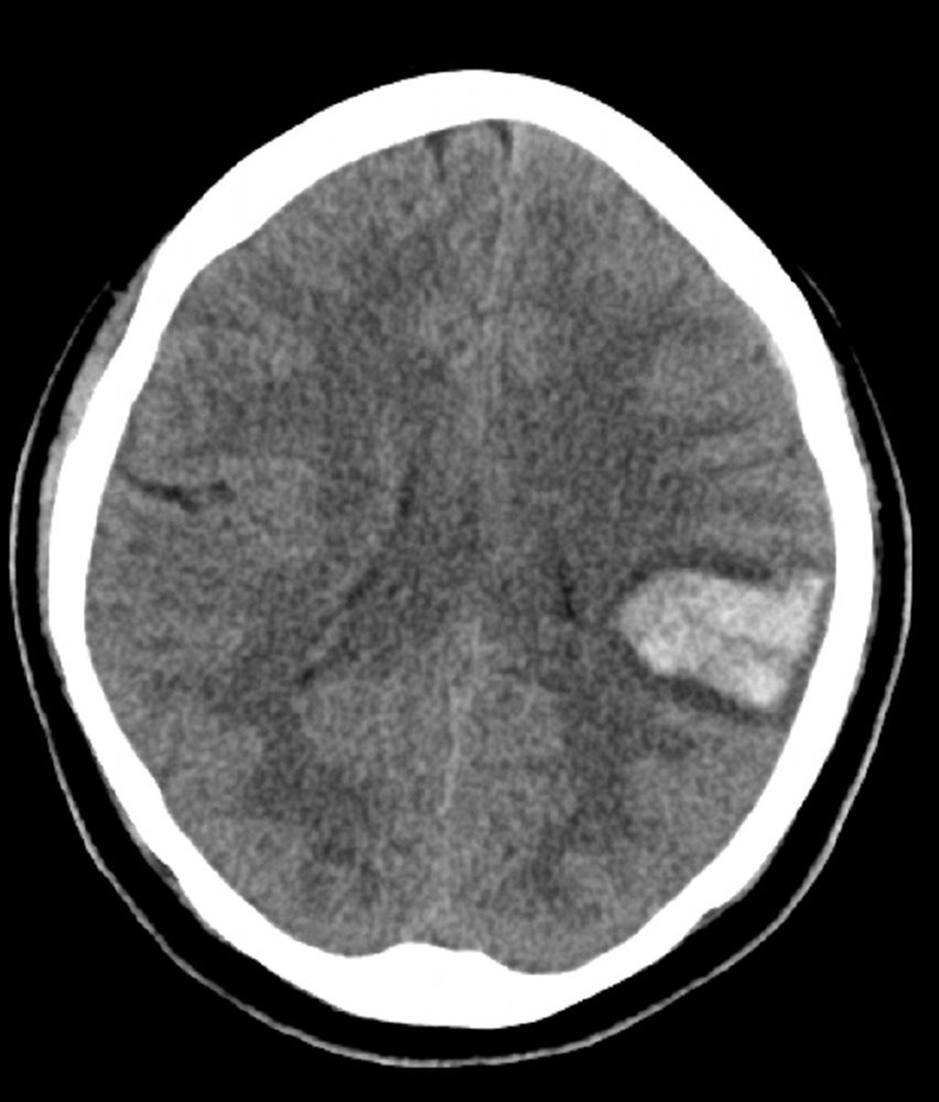 Intracerebral Hemorrhage