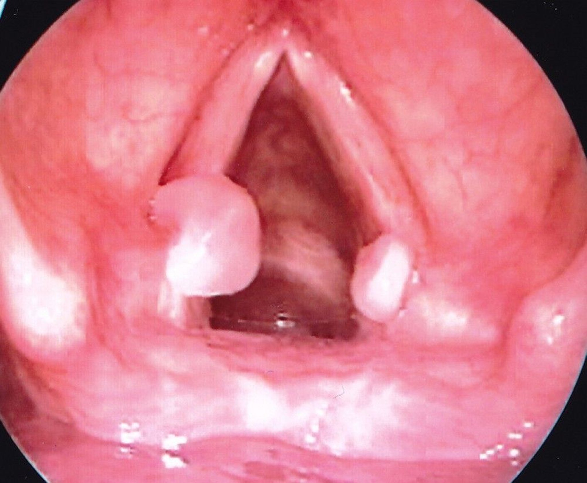Vocal Fold Granulomas