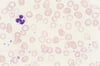 Iron Deficiency Anemia
