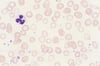 Anemia ferropénica