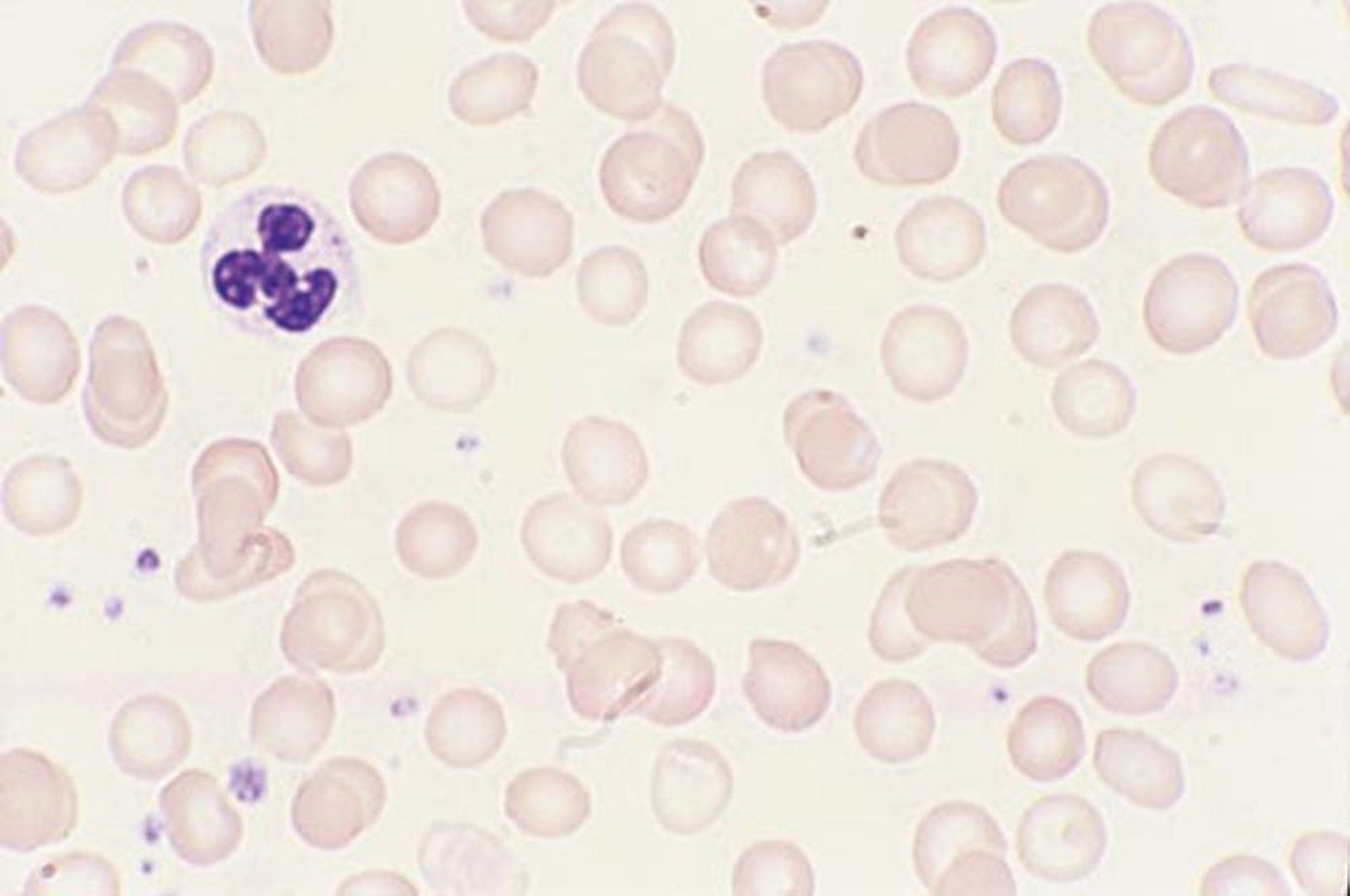 Anemia ferropénica