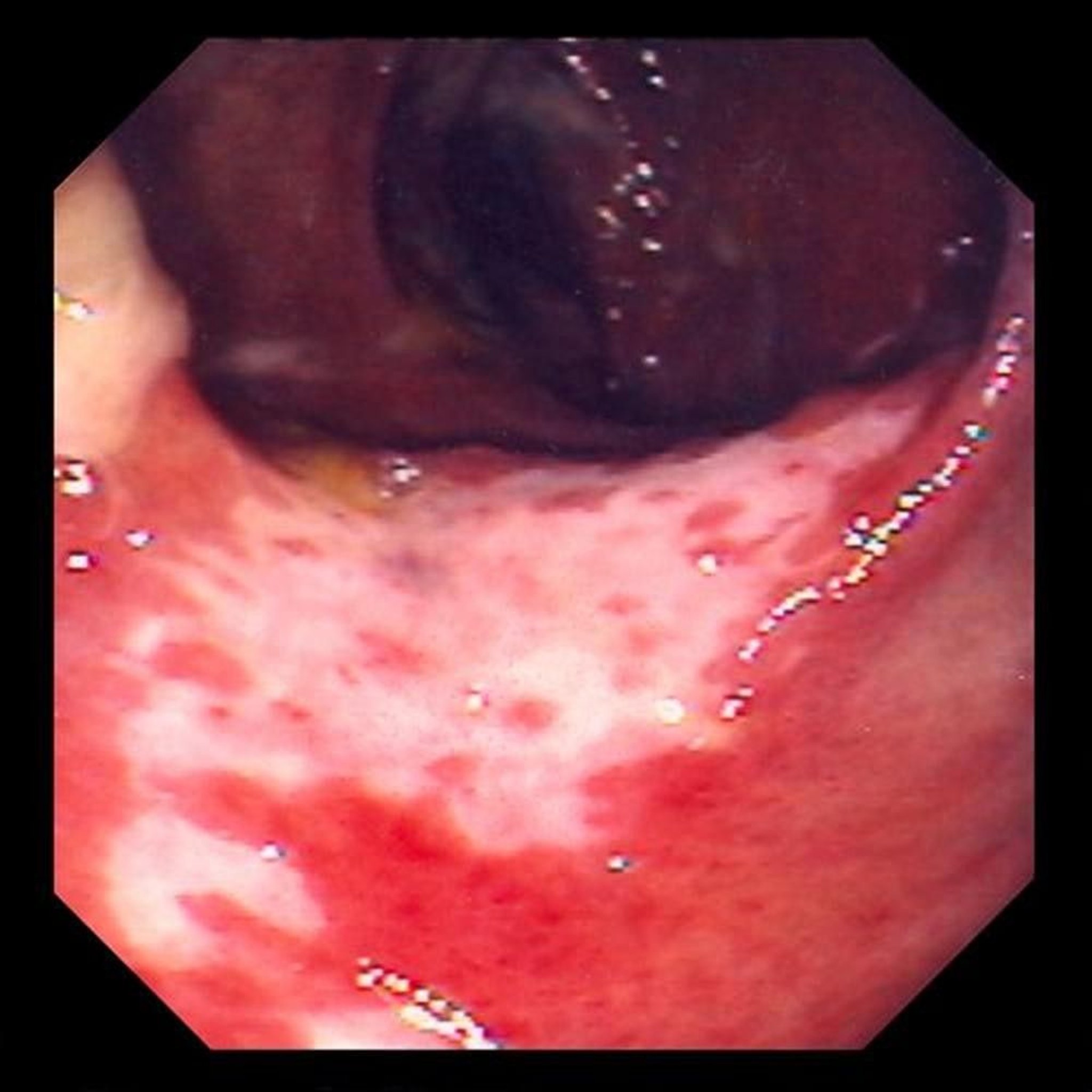 Ischemic Colitis (Colonoscopy)