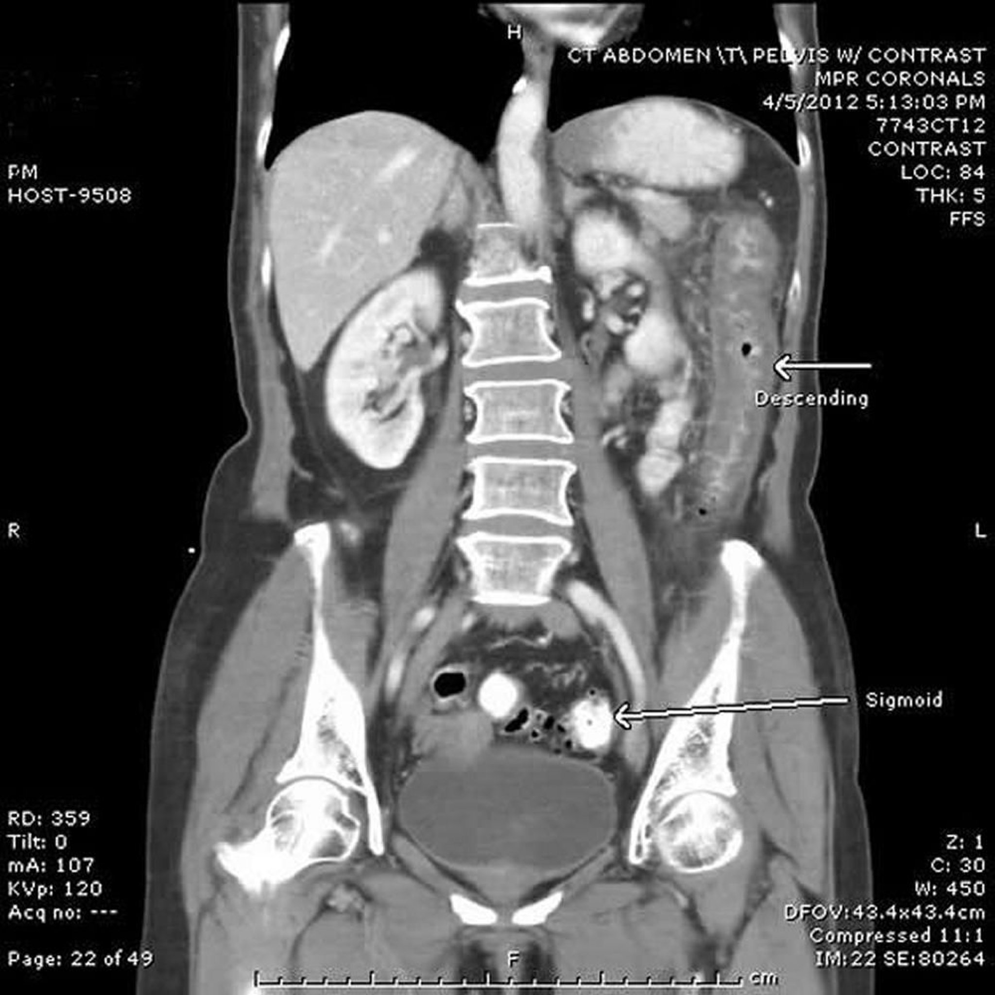 Colitis isquémica (TC)