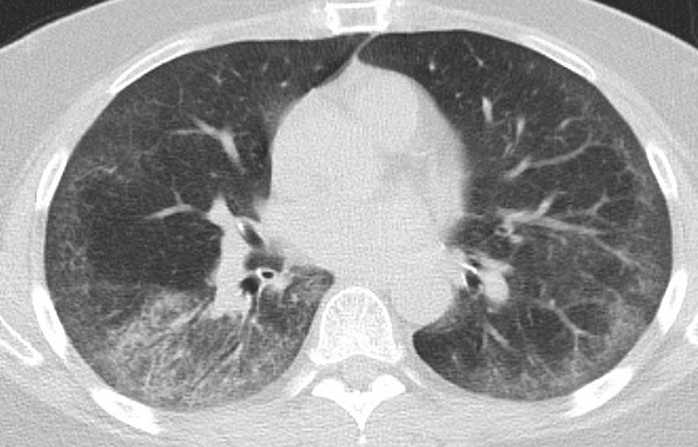 ImageMaladie pulmonaire interstitielle (TDM thoracique)Édition — free download