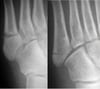 Jones vs Pseudo-Jones Fractures
