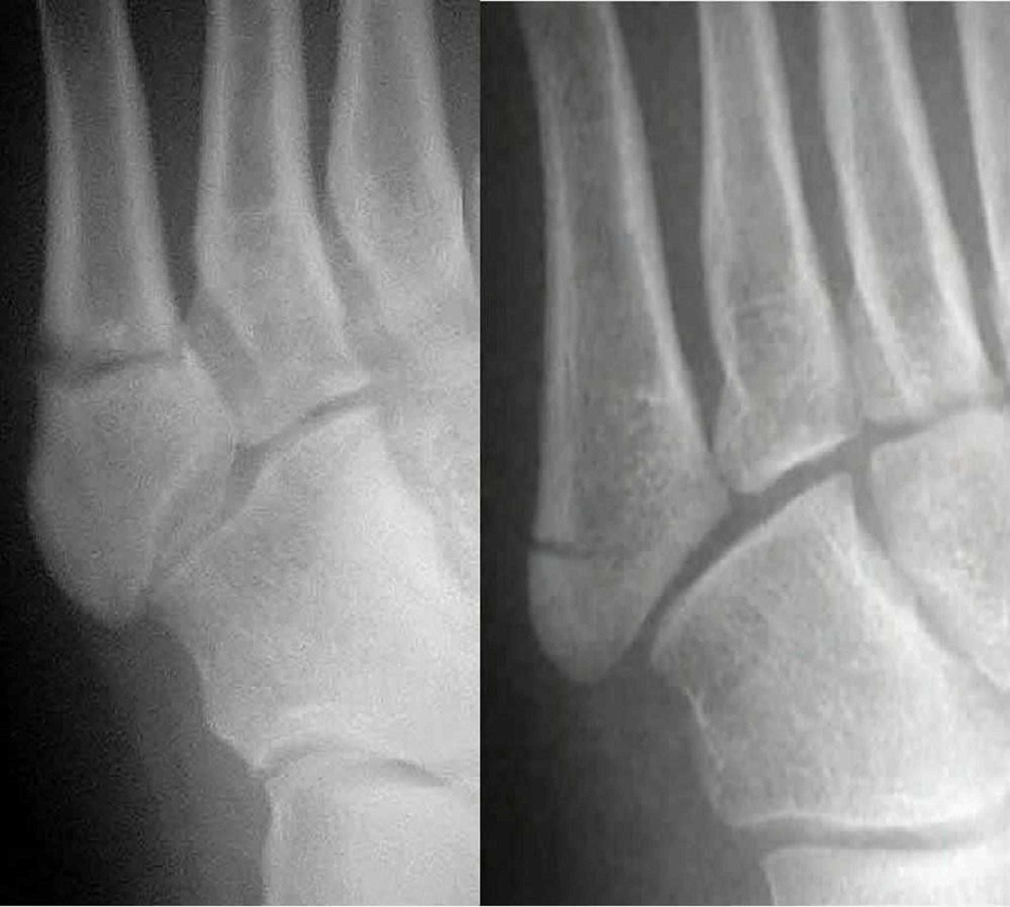 Jones vs Pseudo-Jones Fractures