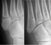 Fractures de Jones versus pseudo-Jones
