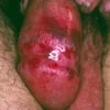Kaposi Sarcoma (Classic Type)