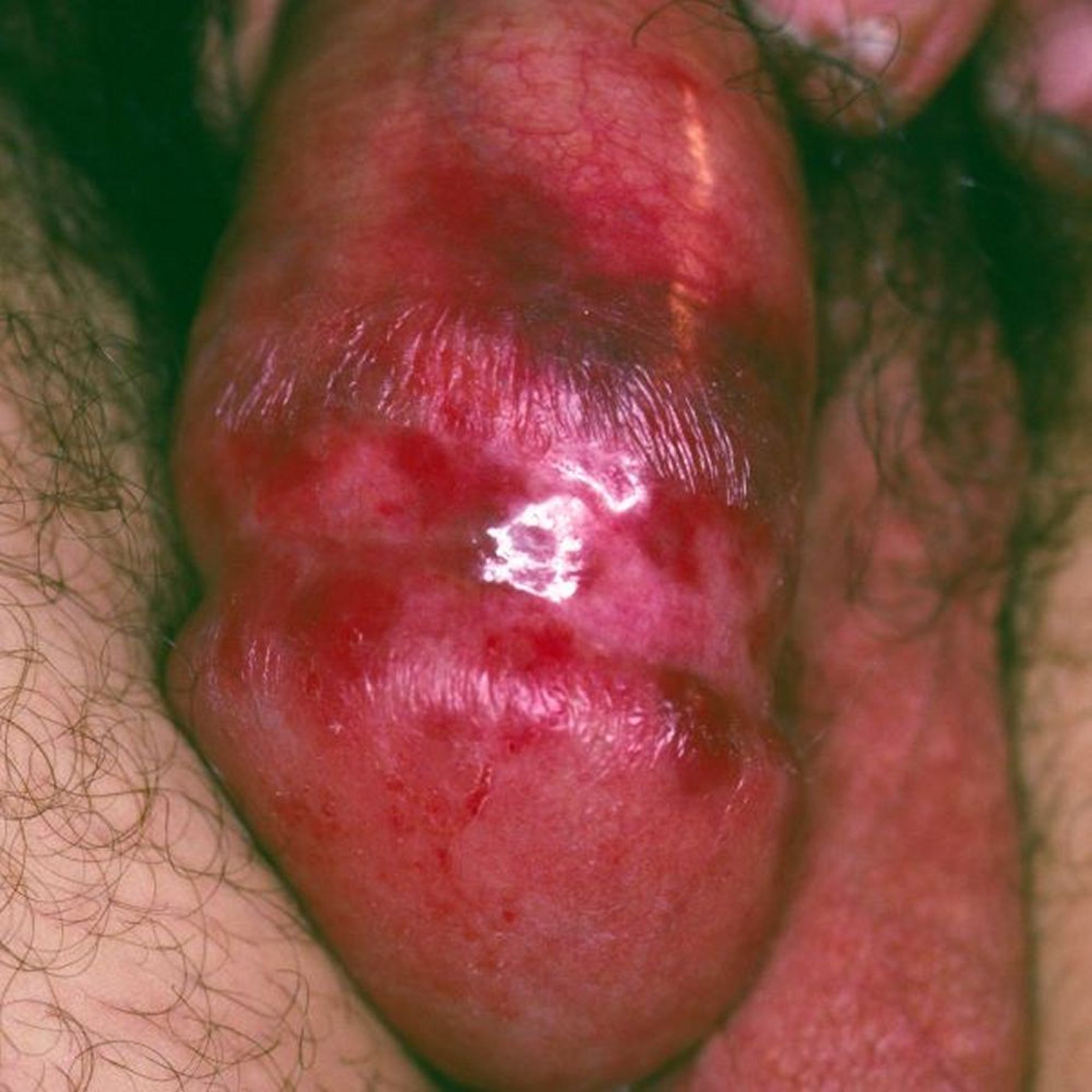 Kaposi-Sarkom (klassischer Typ)