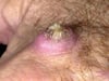Keratoacanthoma