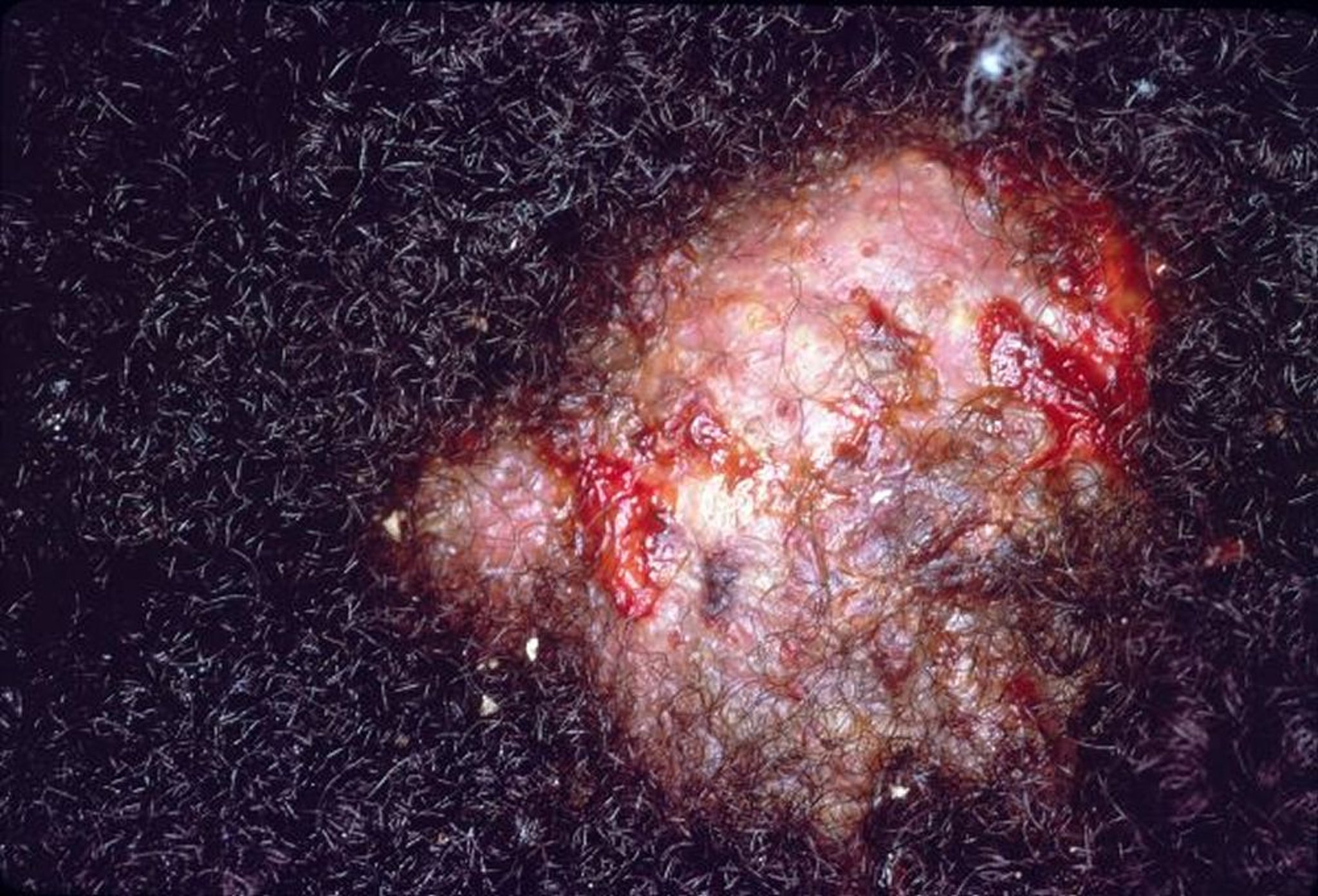 Kerion auf dunkler Haut