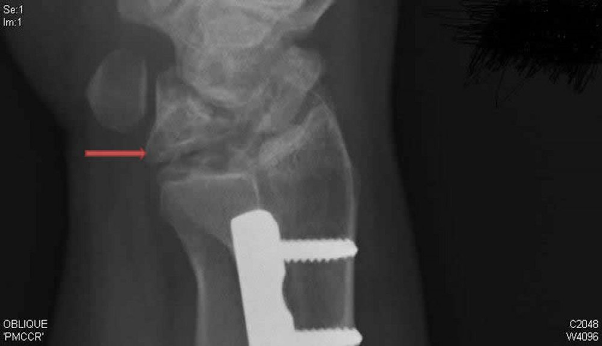 Maladie de Kienböck (radiographie oblique)