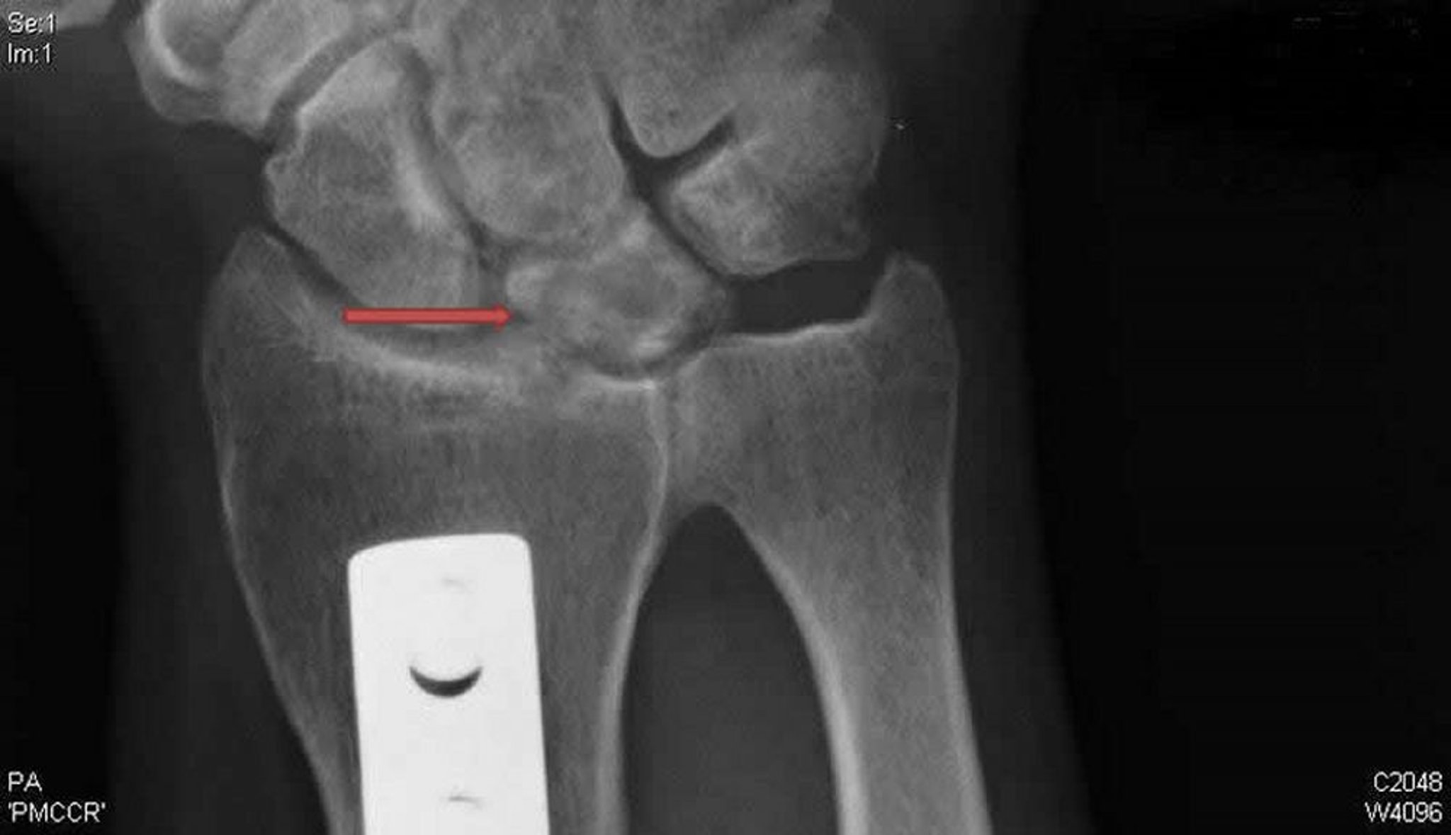 Maladie de Kienböck (radiographie de face)