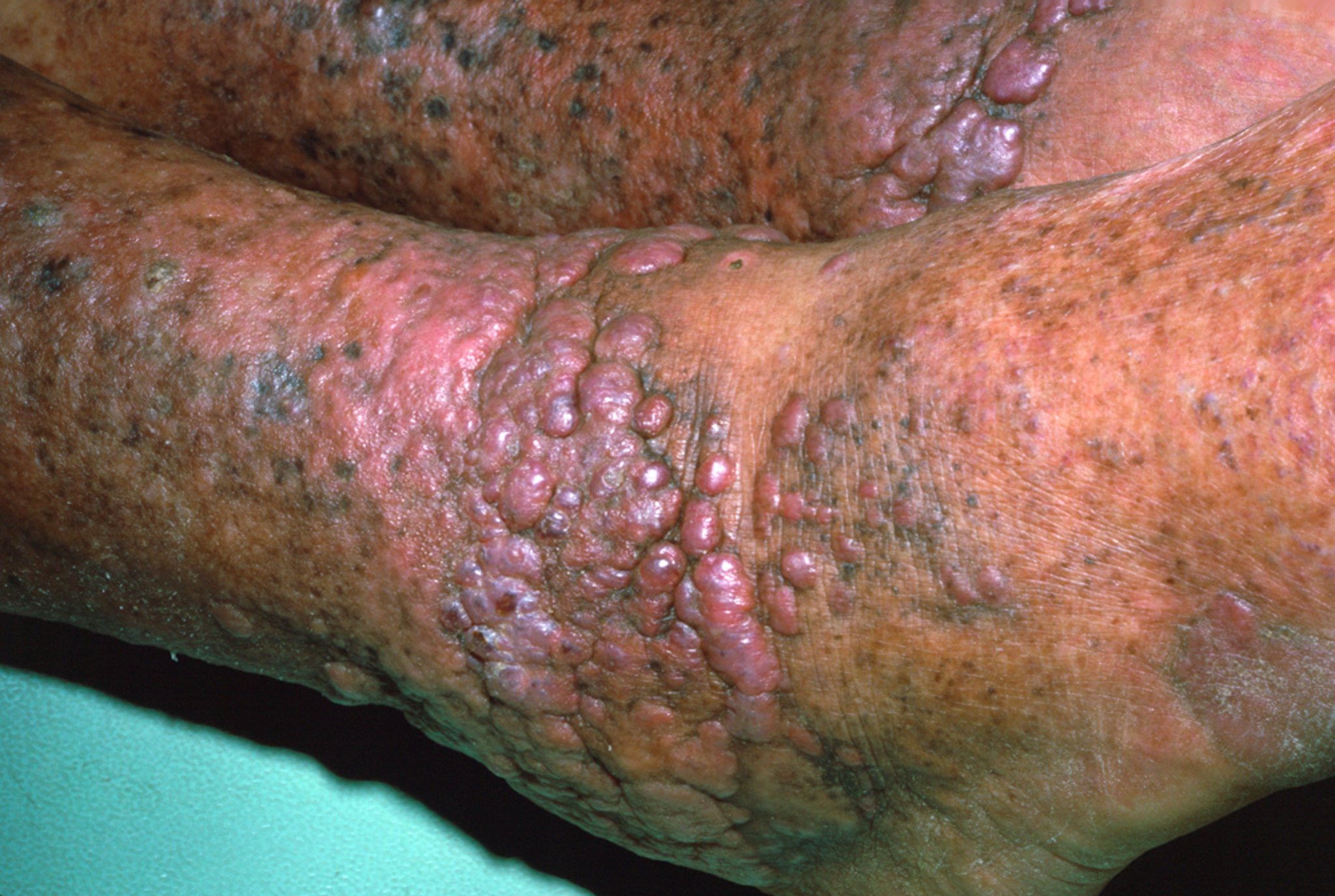 Sarcoma de Kaposi