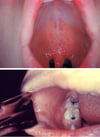 Koplik Spots in Measles (1)
