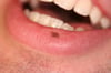 Mácula melanótica labial