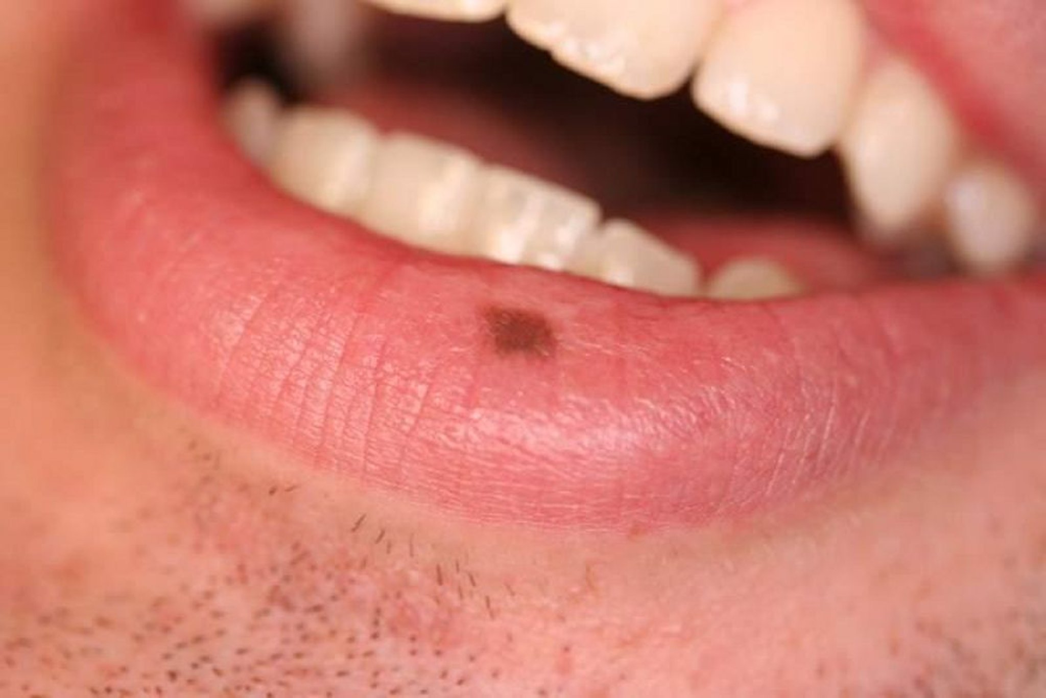Меланотическая макула на губе