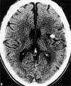 Infarctus lacunaire