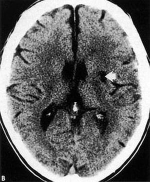 Lacunar Infarct