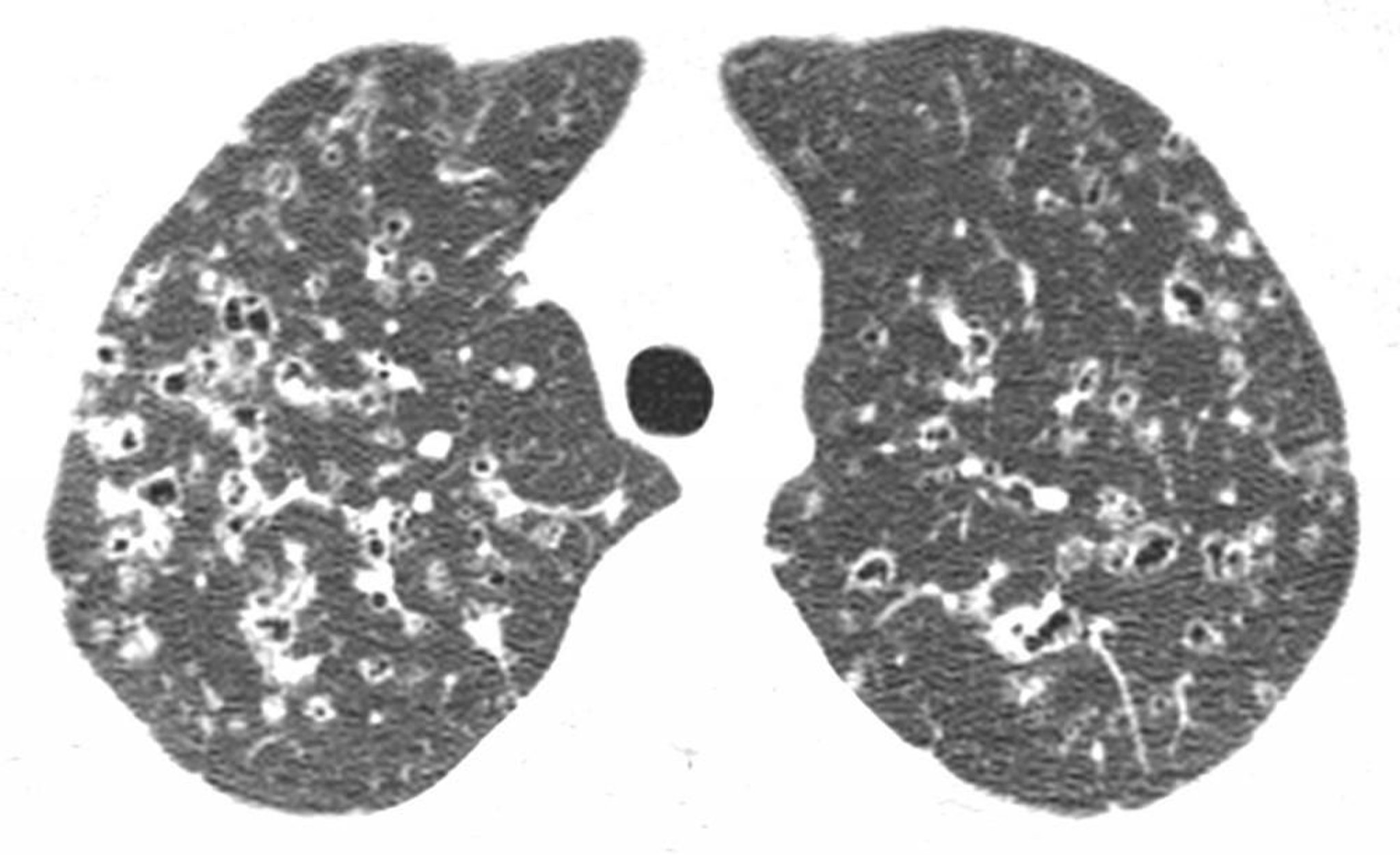 Histiocitosis pulmonar de células de Langerhans