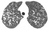 Histiocytose pulmonaire à cellules de Langerhans