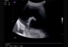 Lateral Thoracic Ultrasound (Left)