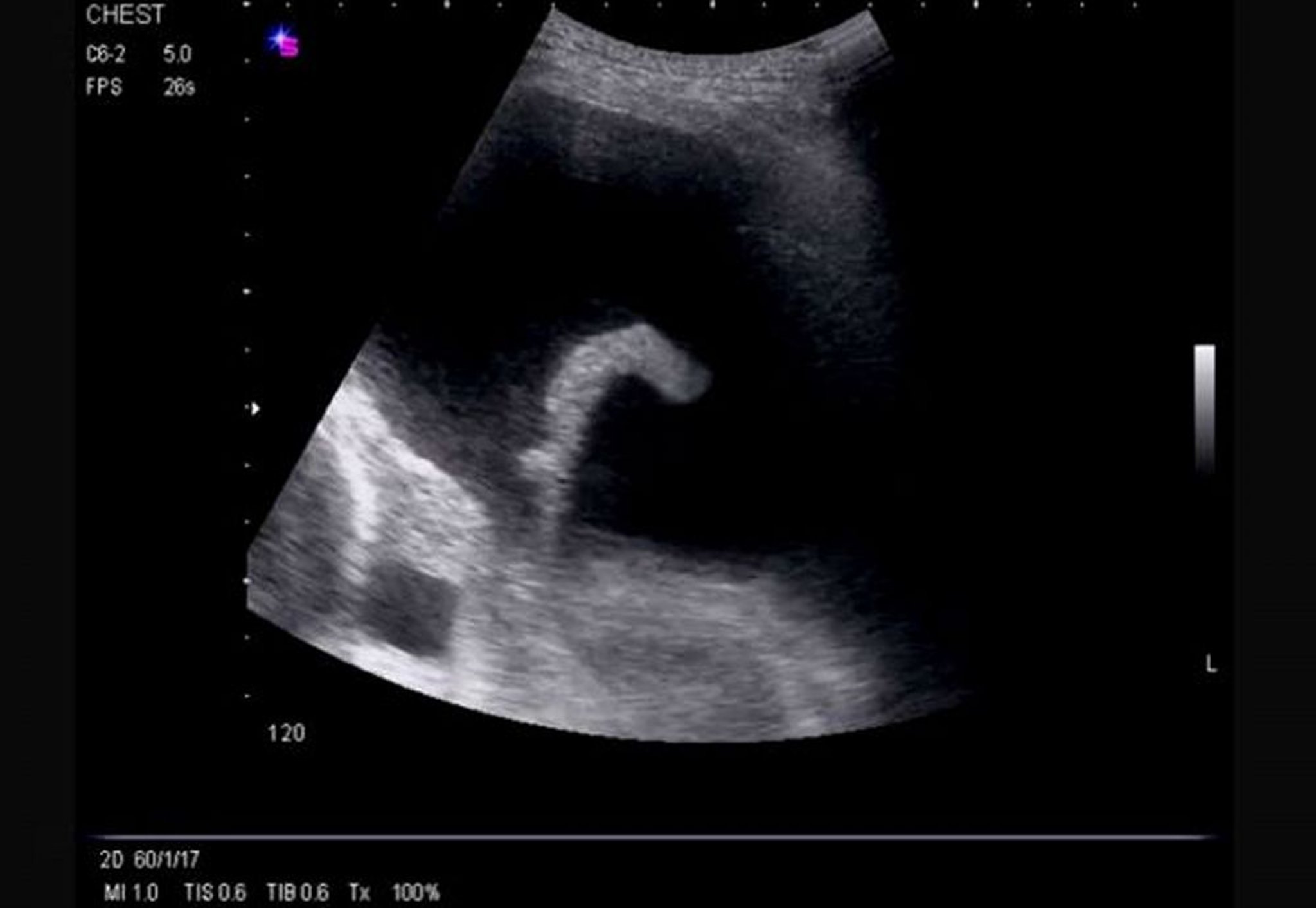 Lateral Thoracic Ultrasound (Left)