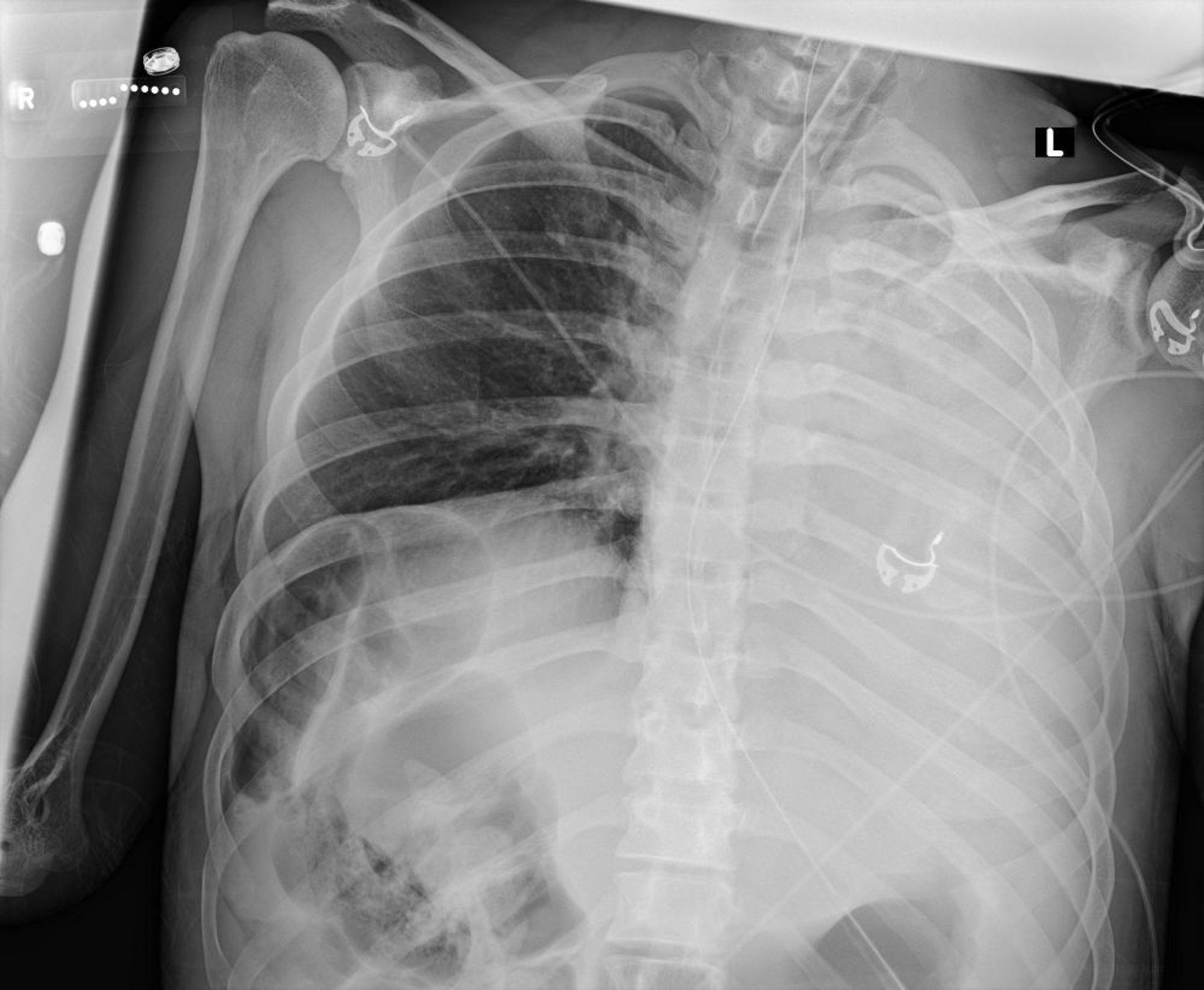 Atélectasie et collapsus du poumon gauche (radiographie)