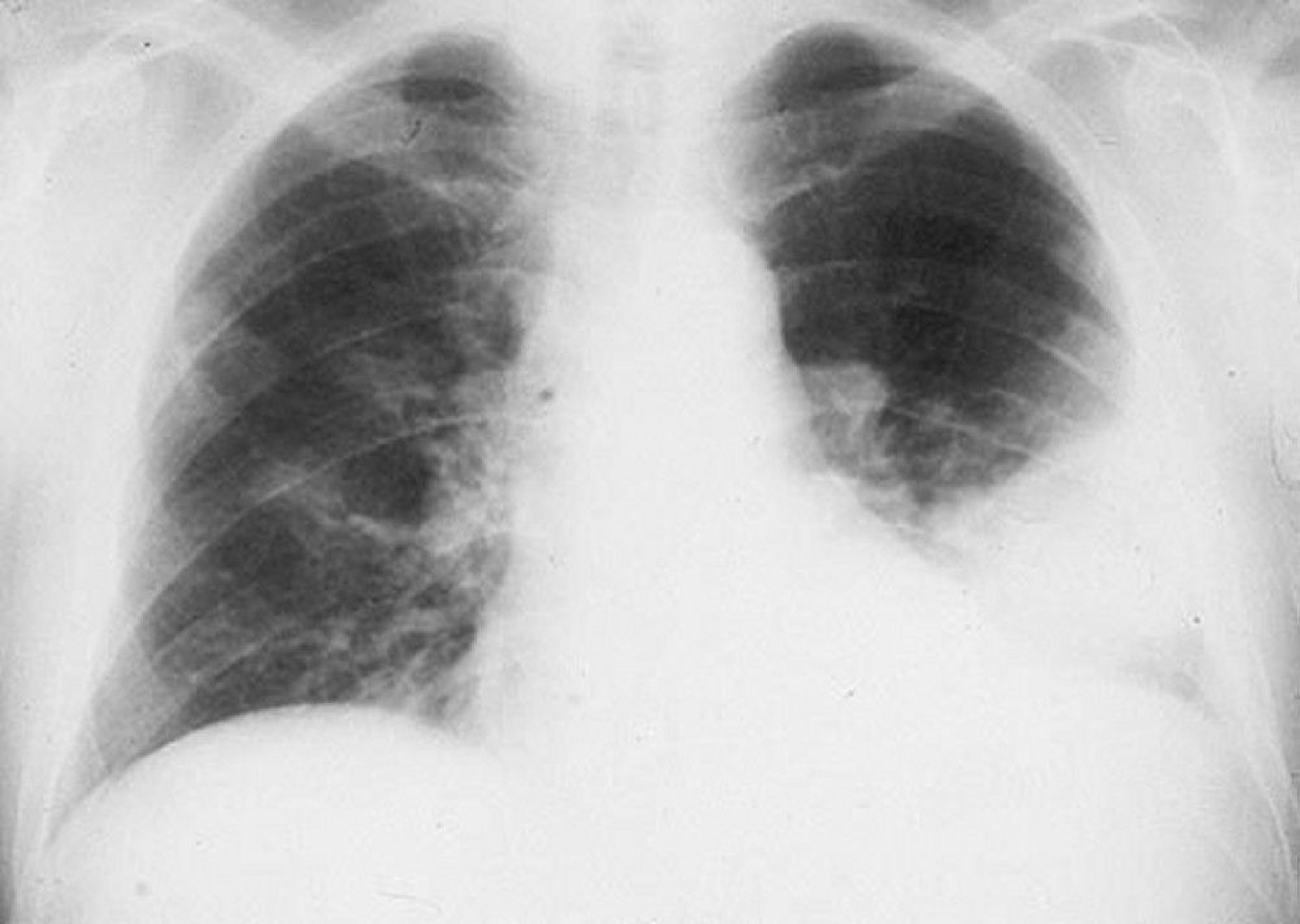 Left Lower Lobe Infiltrate