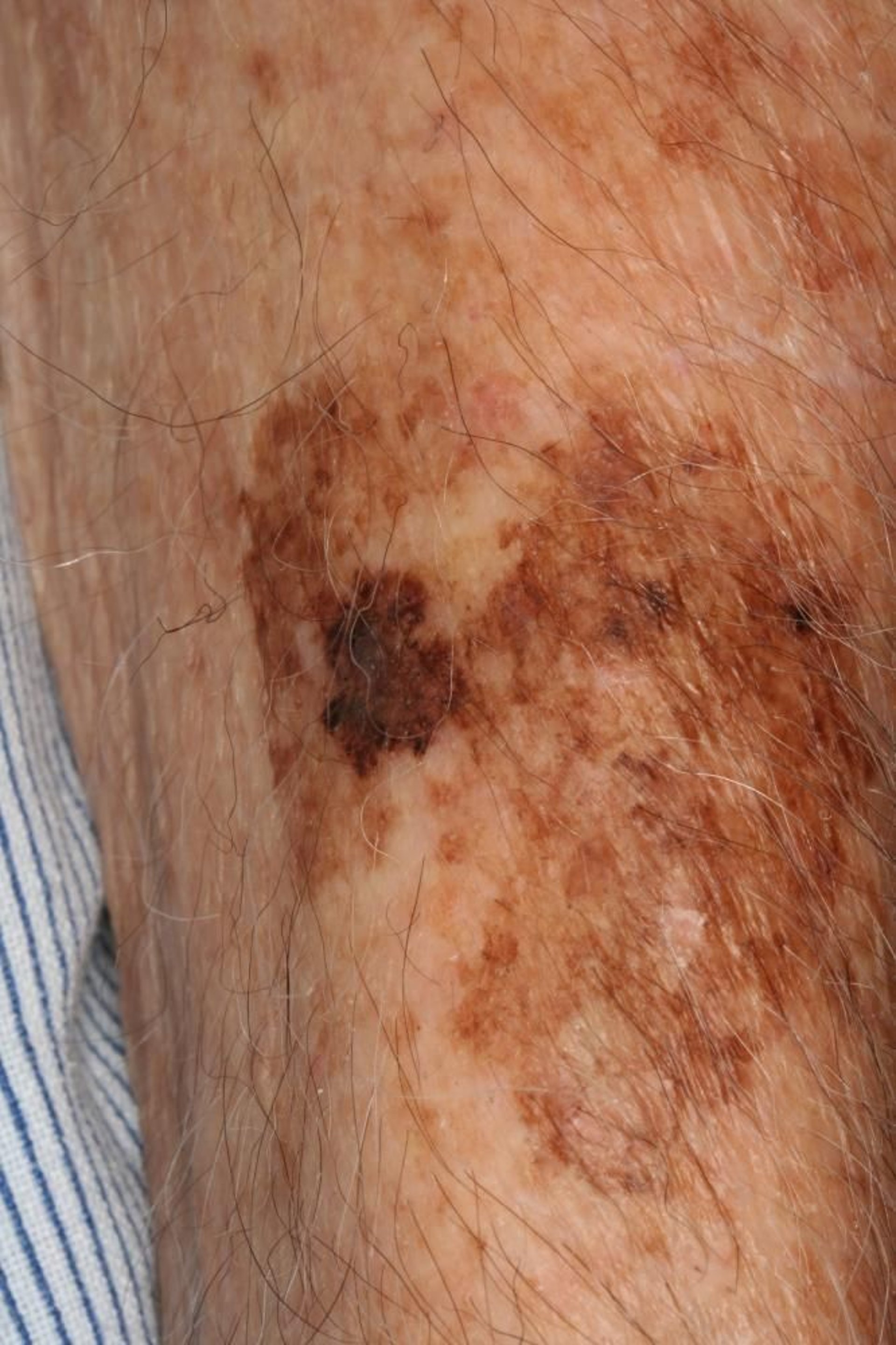 Melanoma de tipo léntigo maligno