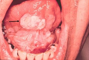 Leucoplaquia e carcinoma de células escamosas