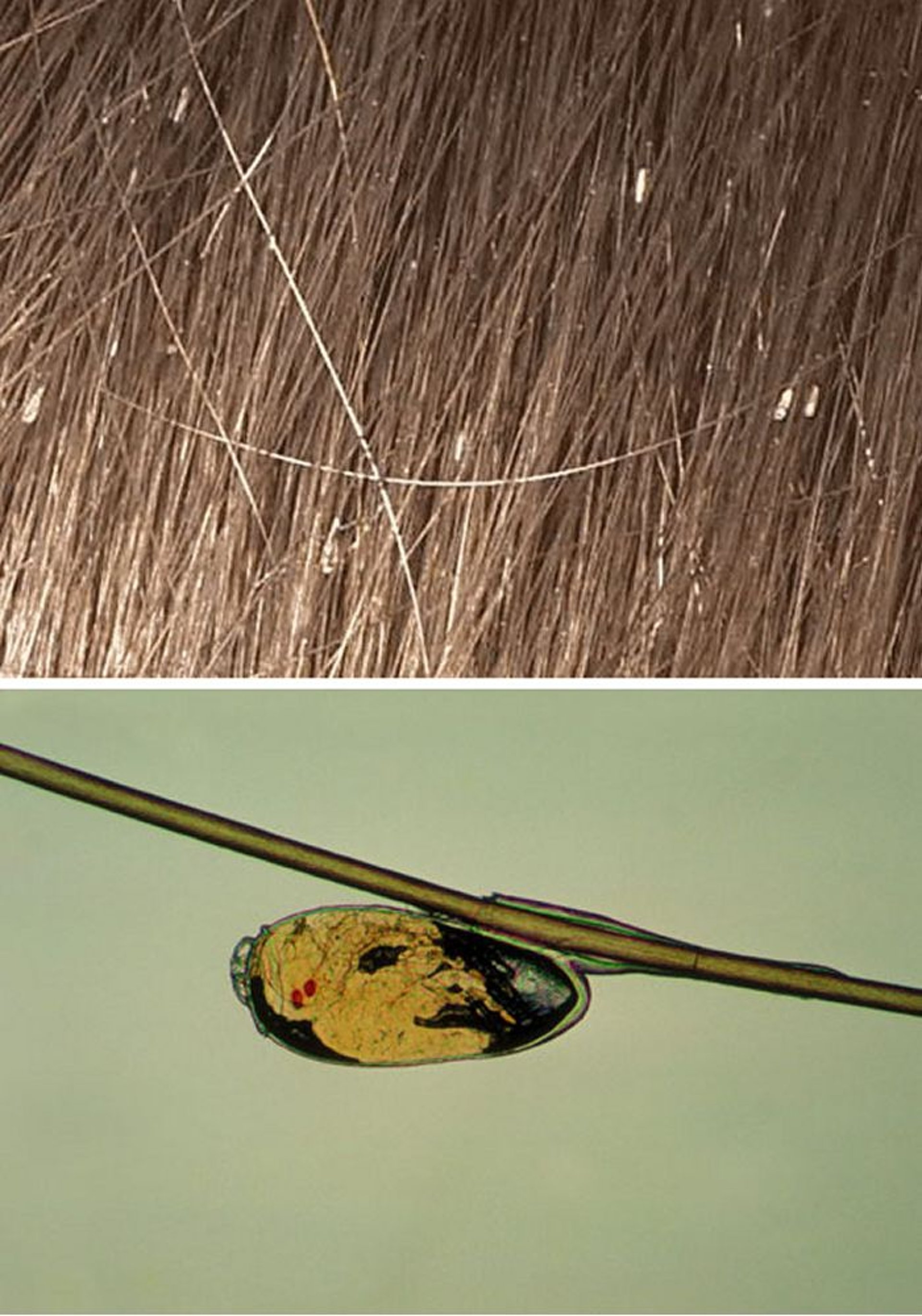 Lice (Head, Nits)