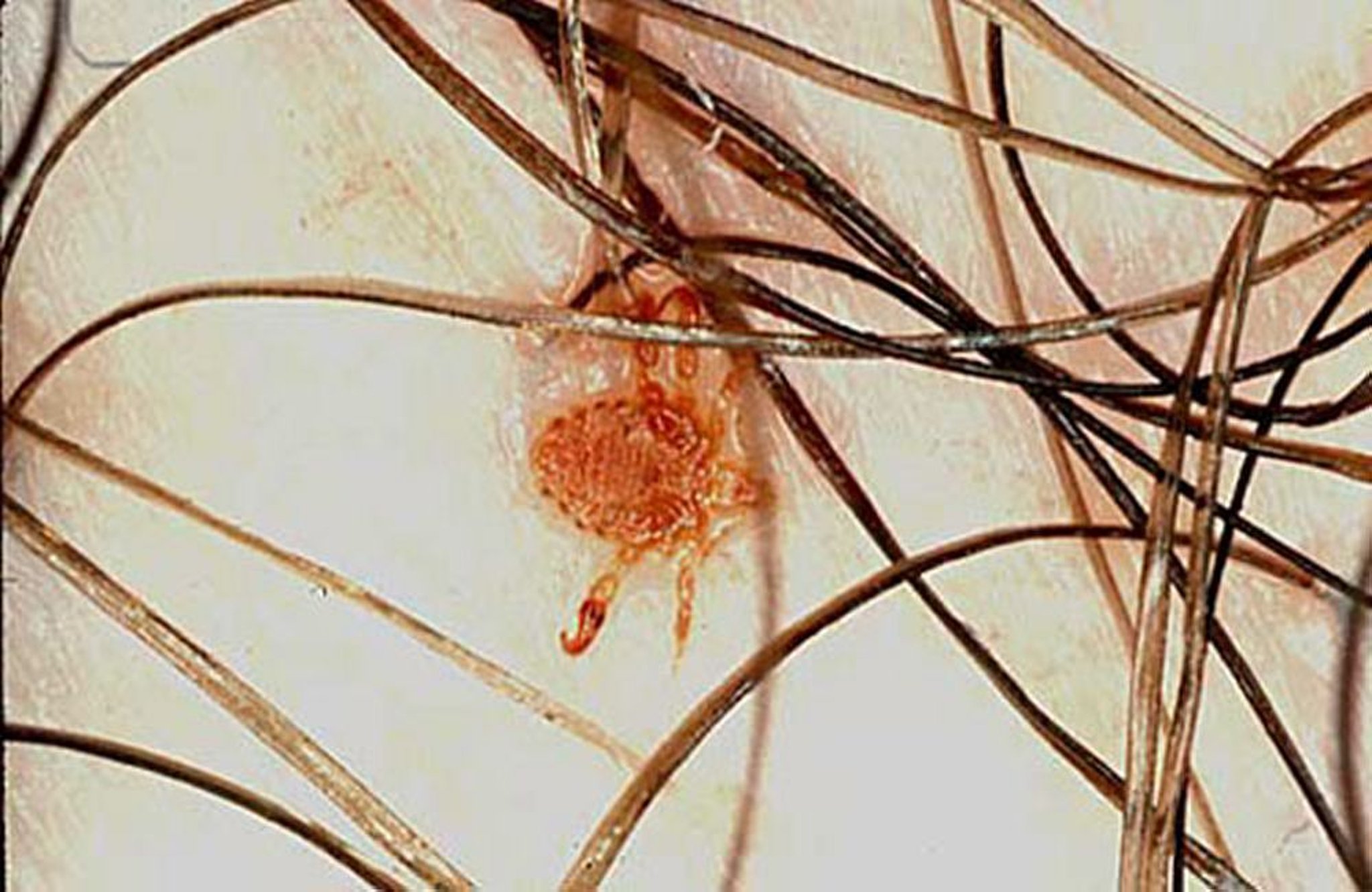 Pediculosis del pubis