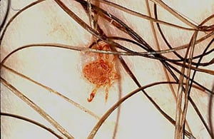 Lice (Pubic)