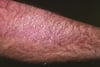 Amiloidosis cutánea por liquen (Brazo)