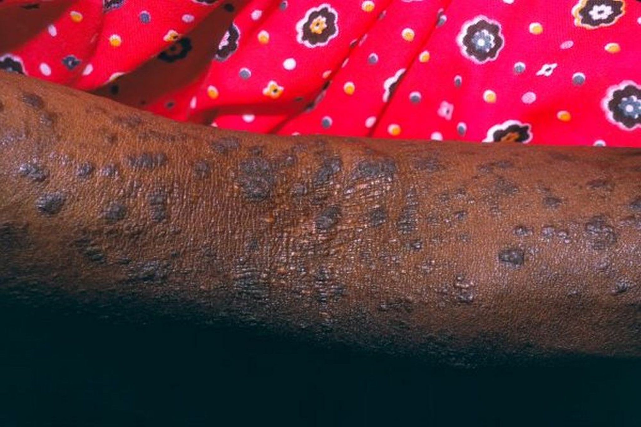 Lichen Planus (Arm)