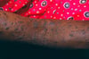 Liquen plano (Brazo)