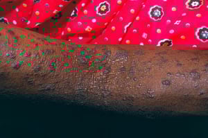 Плоский лишай (руки)