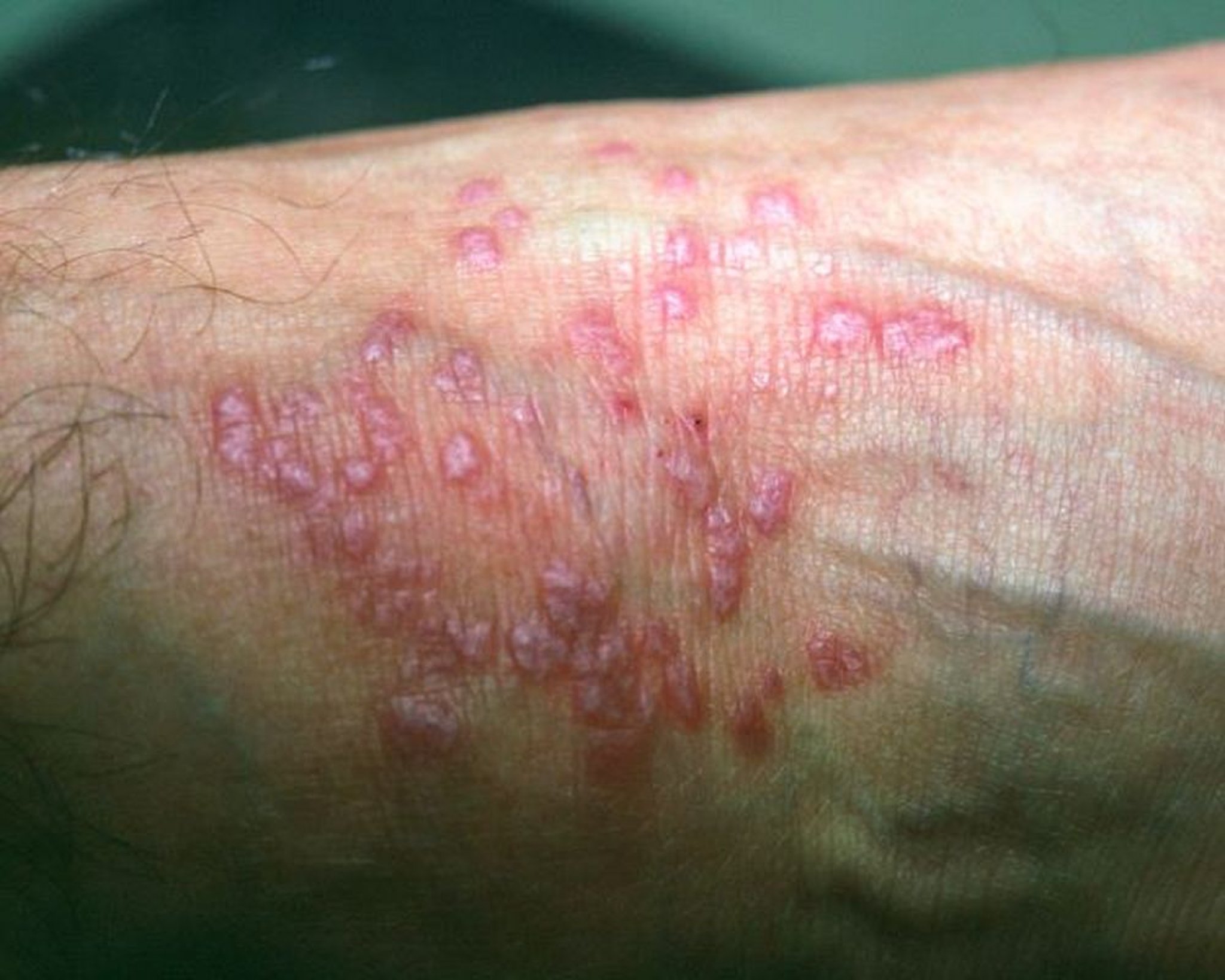 Liquen plano (antebrazo)