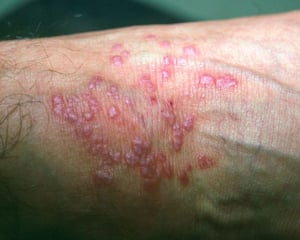 Плоский лишай (передпліччя)