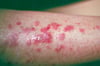 Lichen Planus