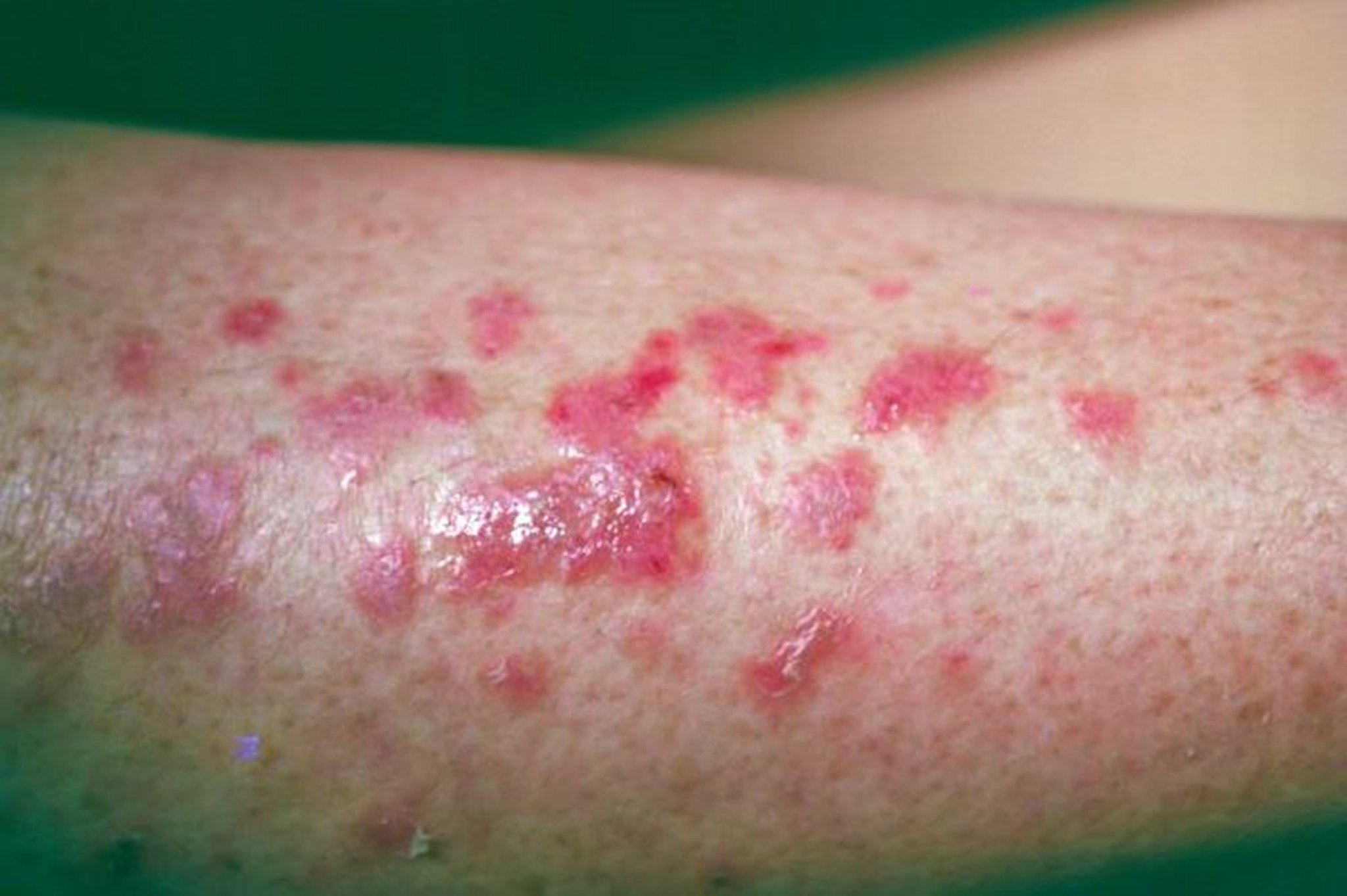 Lichen planus
