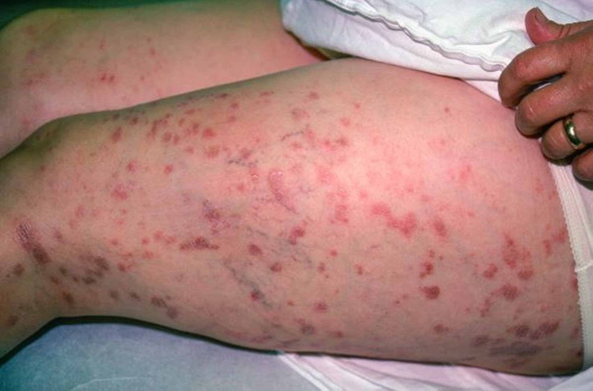 Lichen plan (cuisse)