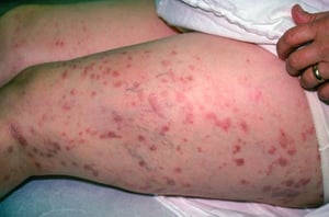 Lichen plan (cuisse)