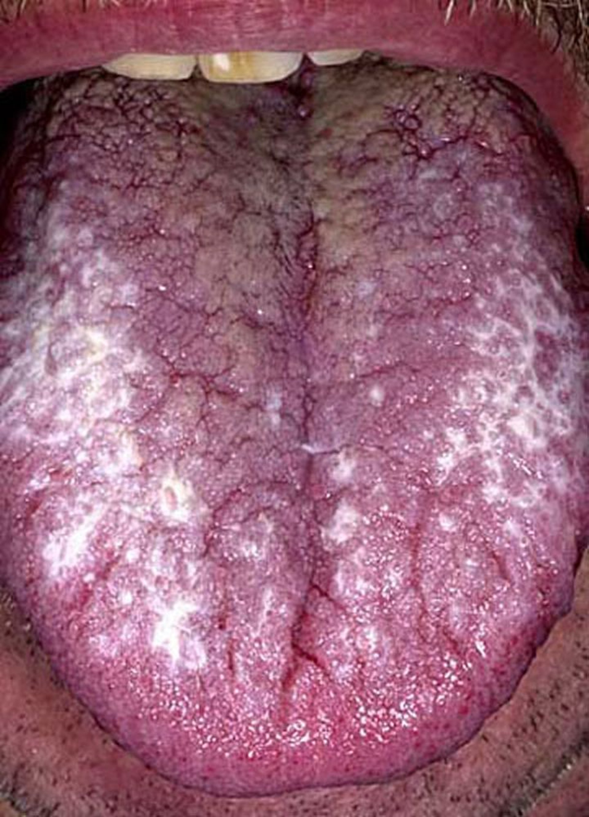 Lichen Planus (Oral)