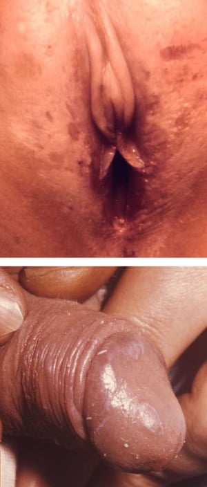 Lichen sclerosus