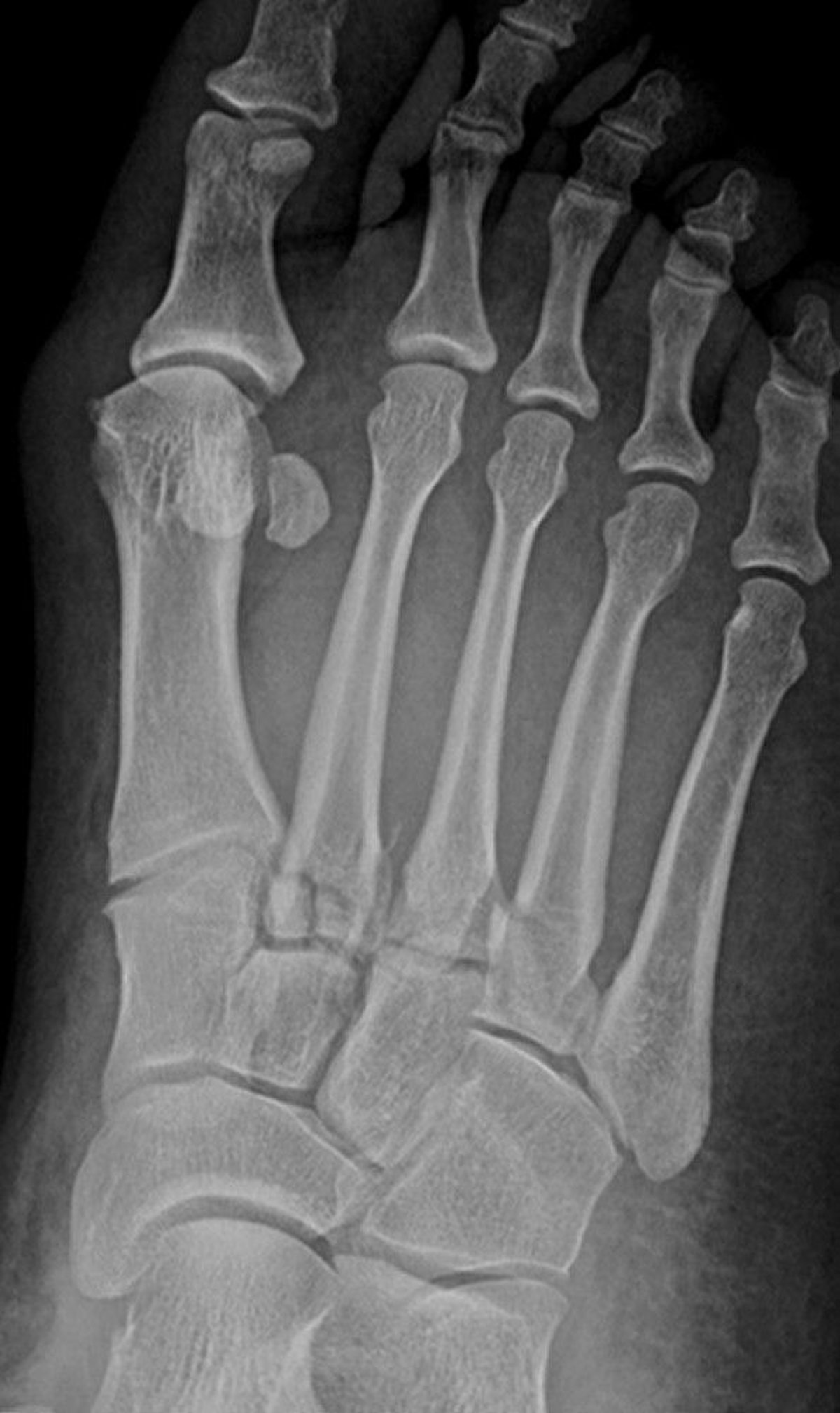 Lisfranc Fractures