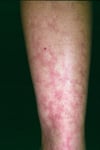 Livedo reticular (Livedo Reticularis) (Pierna)