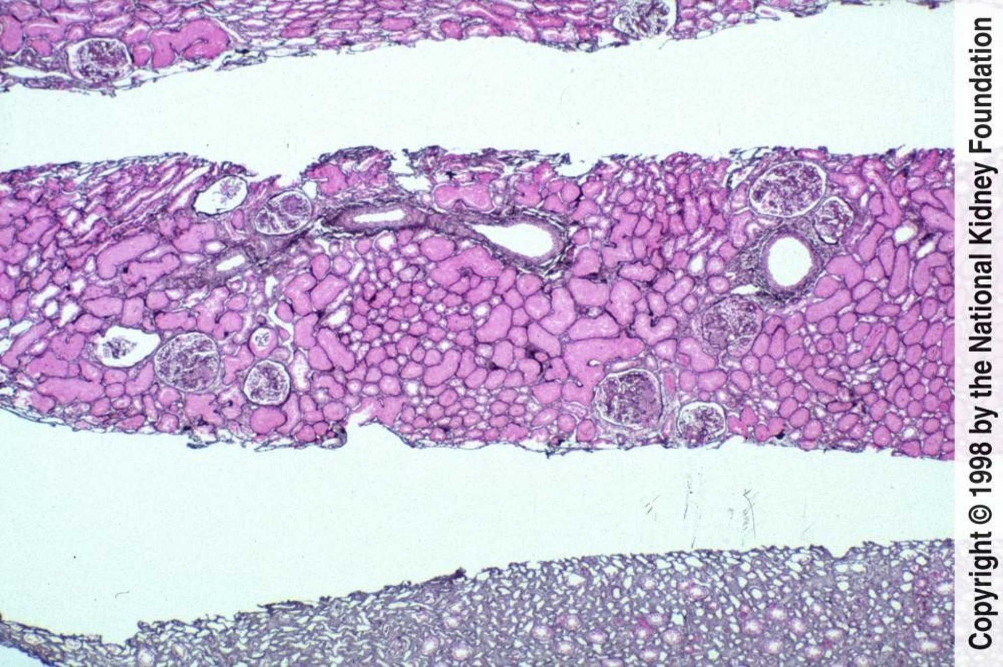 Lupus Nephritis—Focal (Class III)